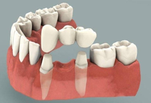 ایمپلنت دندانی در مقایسه با بریج: کدام یک برای شما مناسب است؟