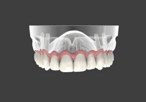 دندان مصنوعی اسنپ این چقدر ماندگار است؟